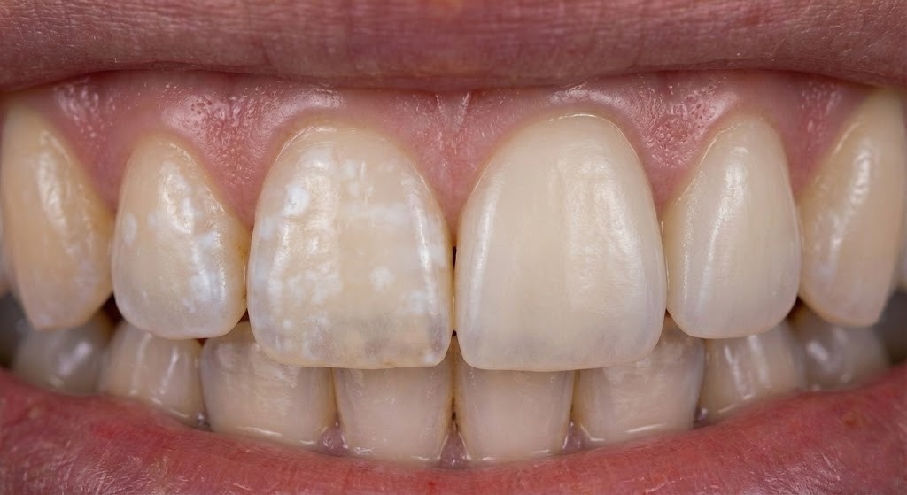 Fluorosis Treatment