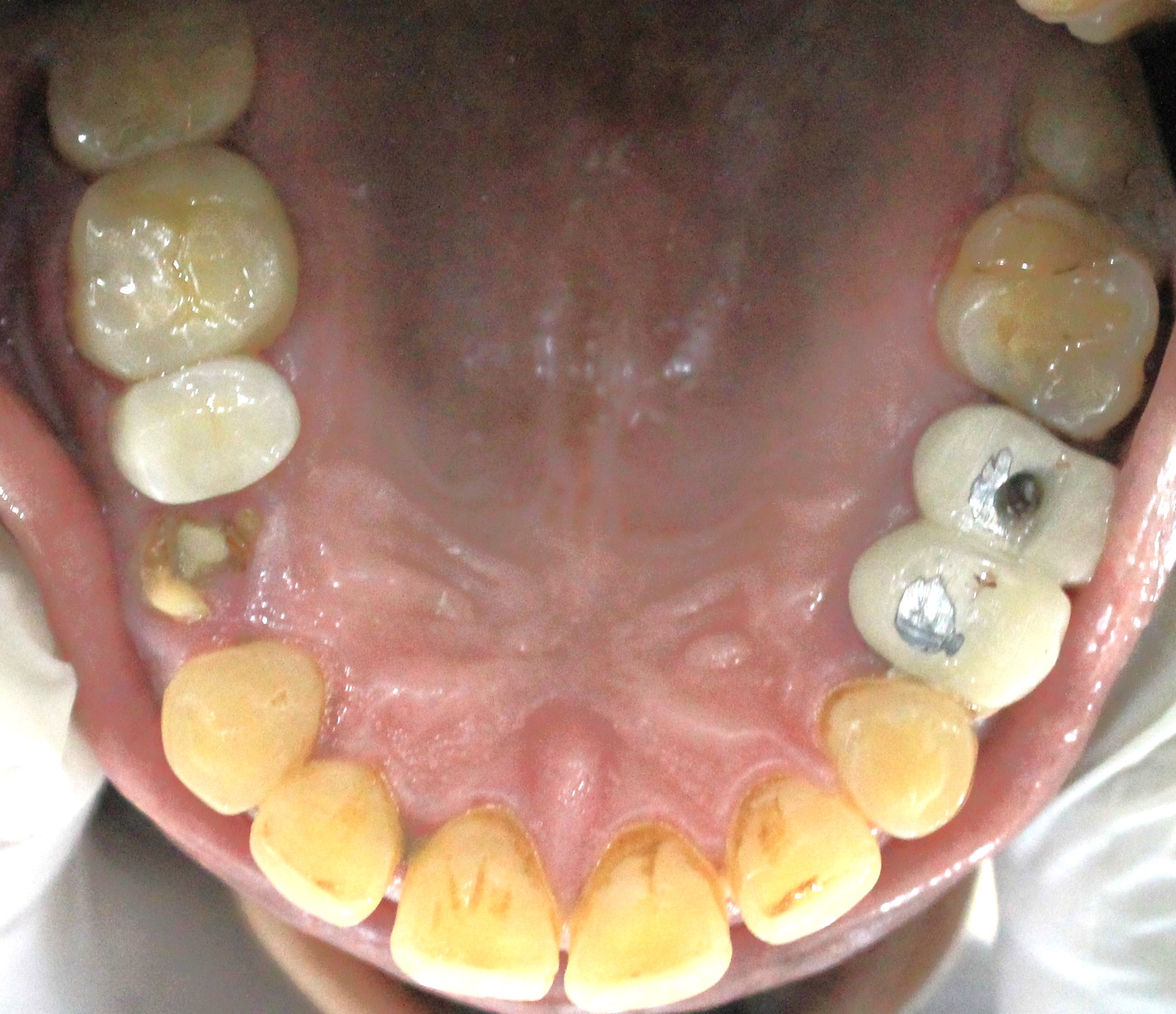 Kaushal Goyal before implant