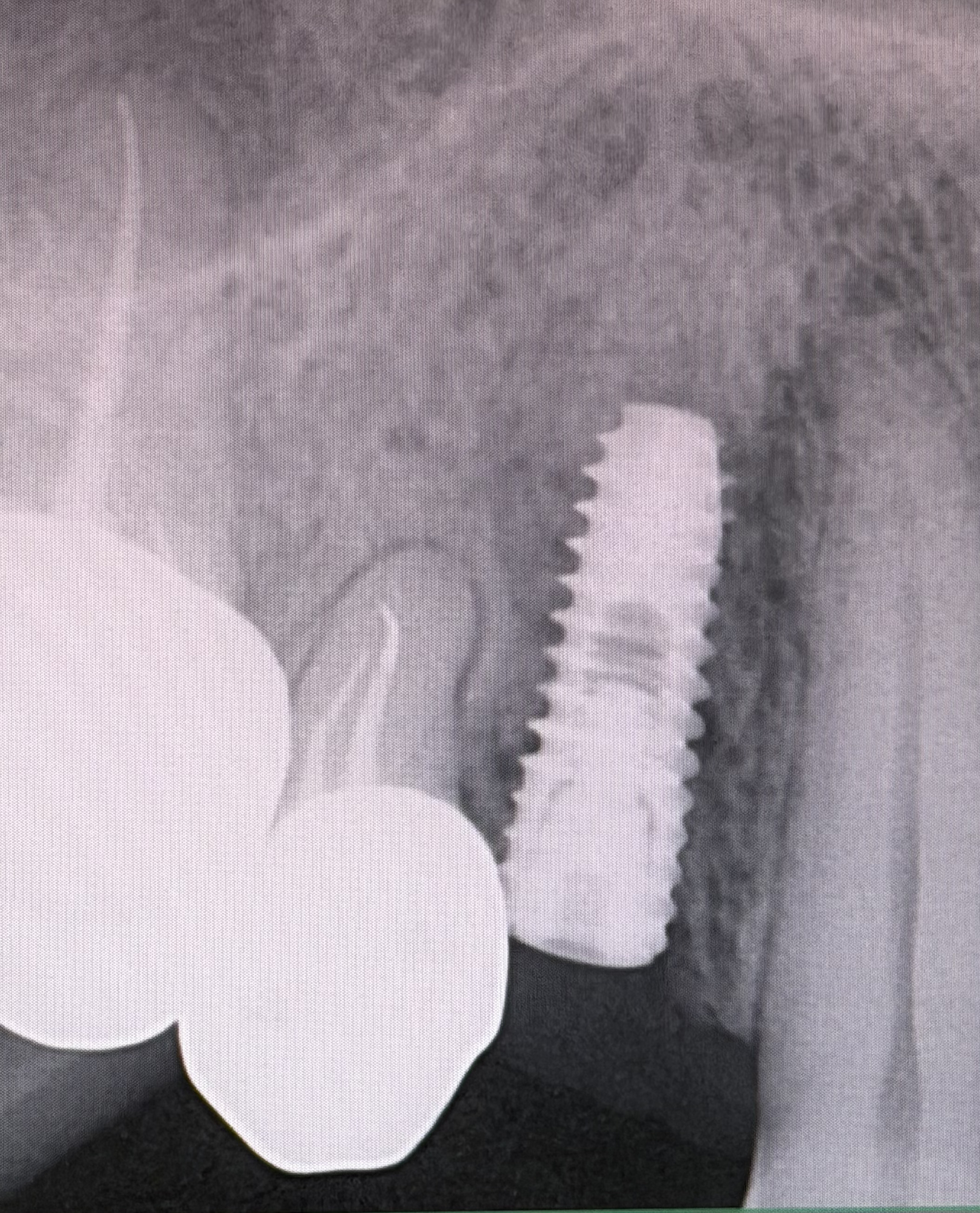 Kaushal Goyal implant x-ray