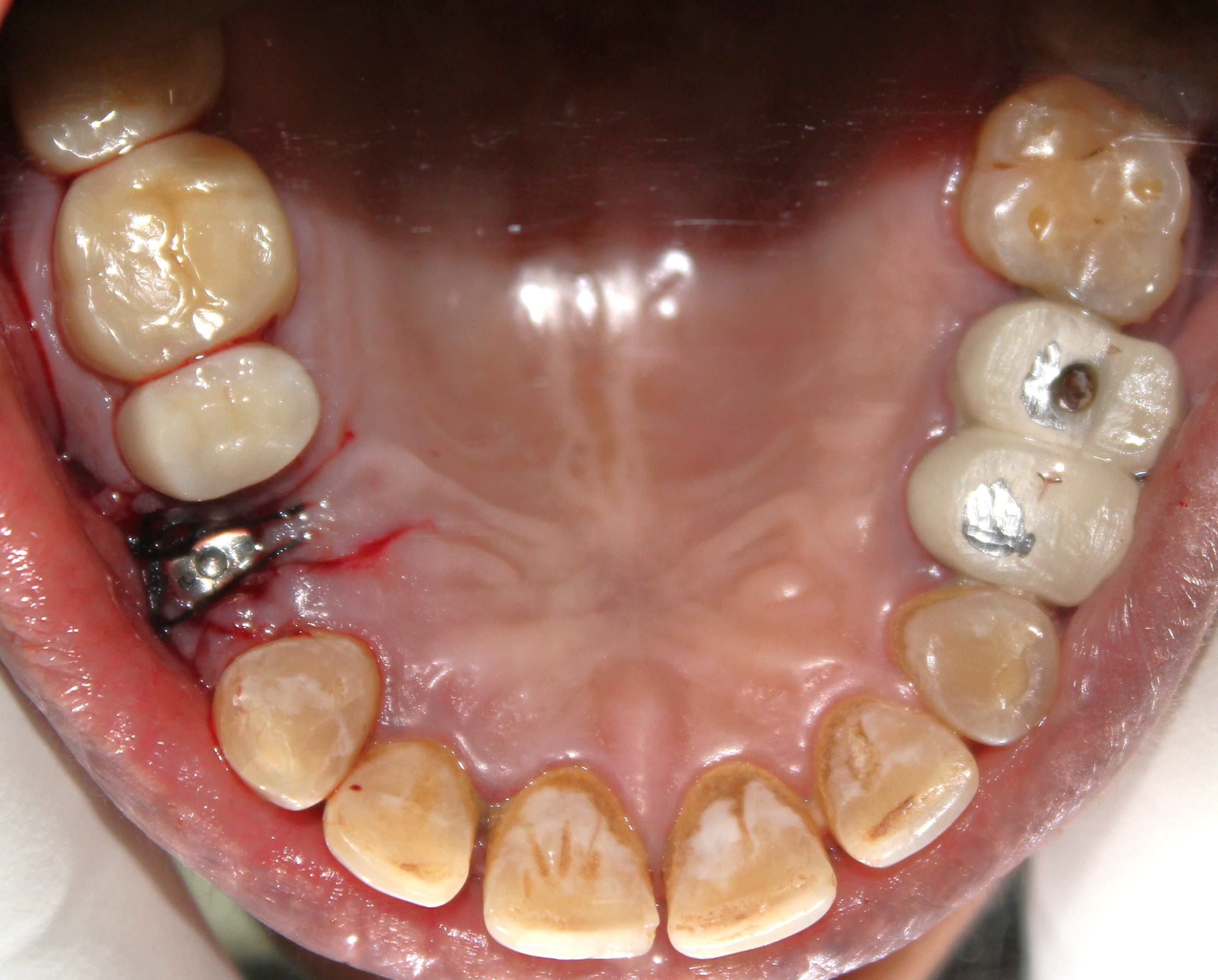 Kaushal Goyal after implant