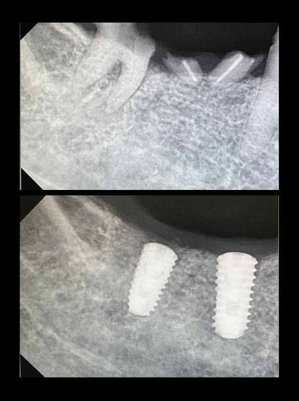 Meenakshi Sharma implant x-ray