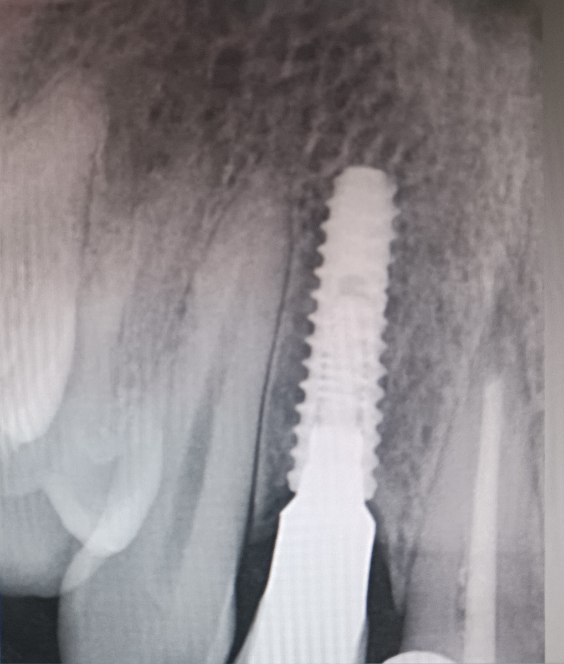 Nitish implant x-ray