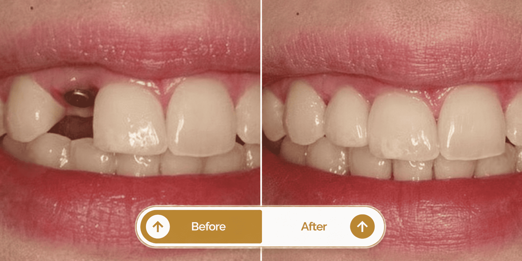 Smile transformation 4