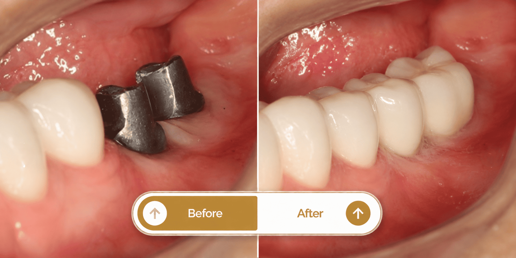 Smile transformation 3