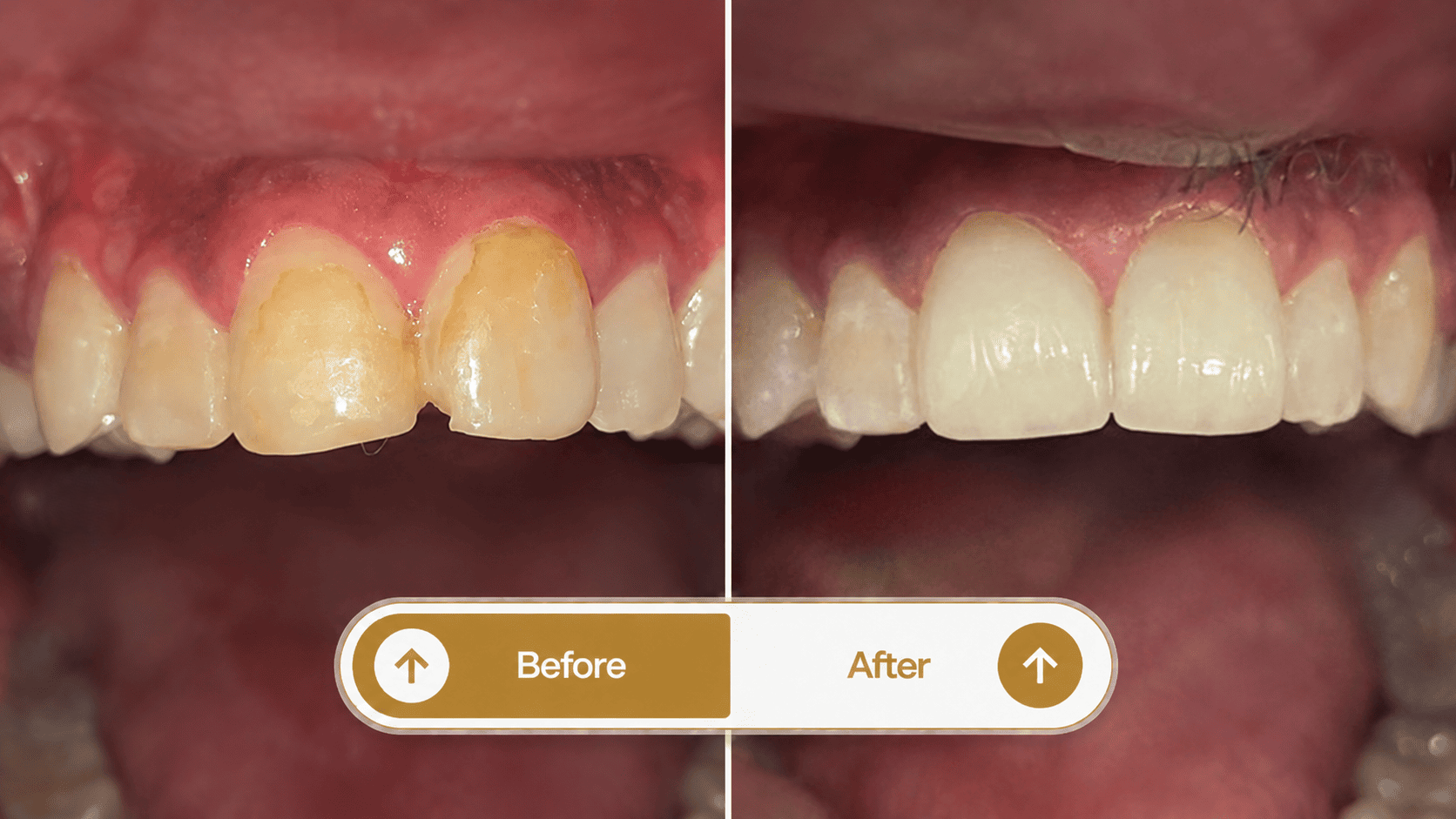 Smile transformation 4