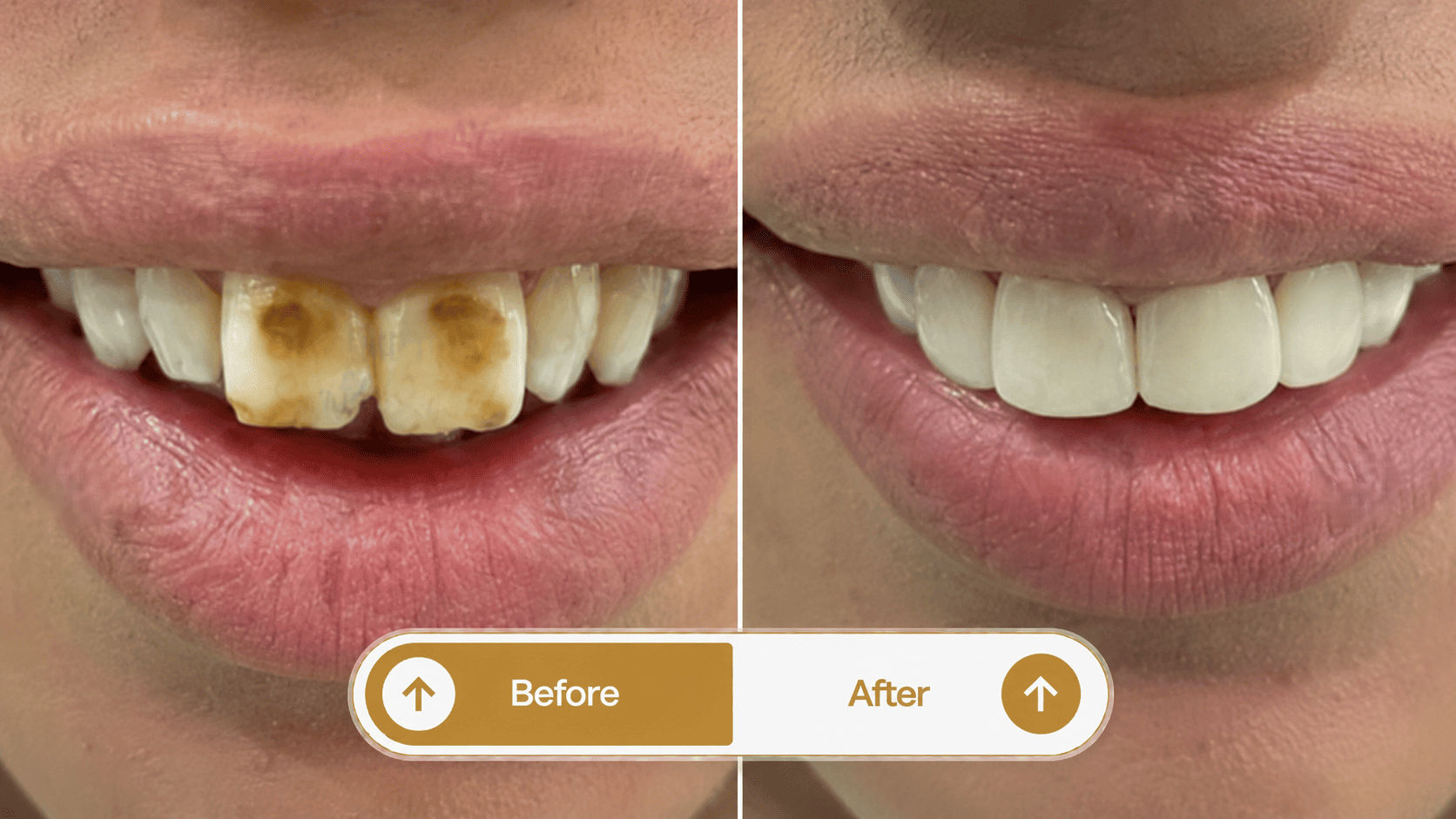 Smile transformation 4