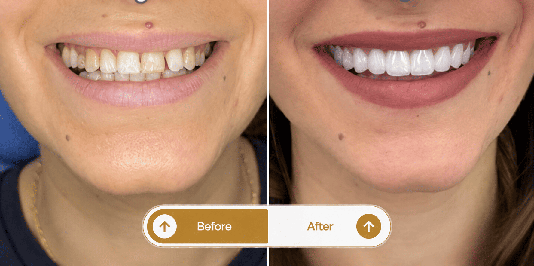Smile transformation 3