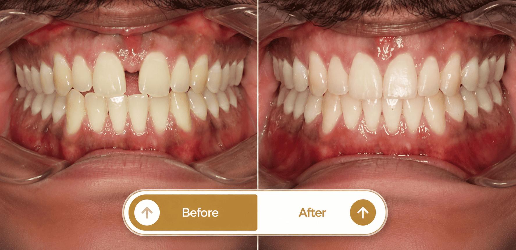 Smile transformation 3