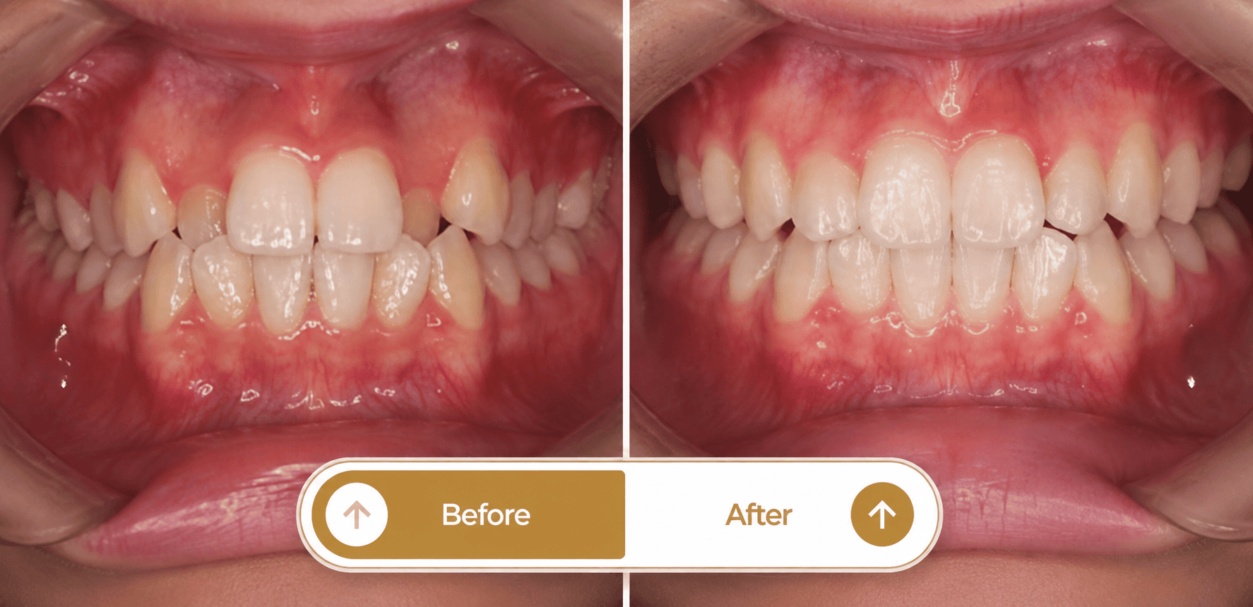 Smile transformation 4