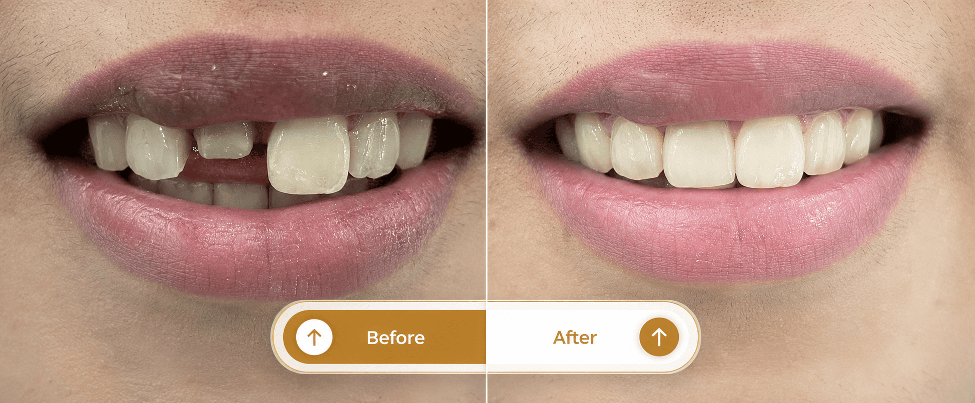 Smile transformation 1