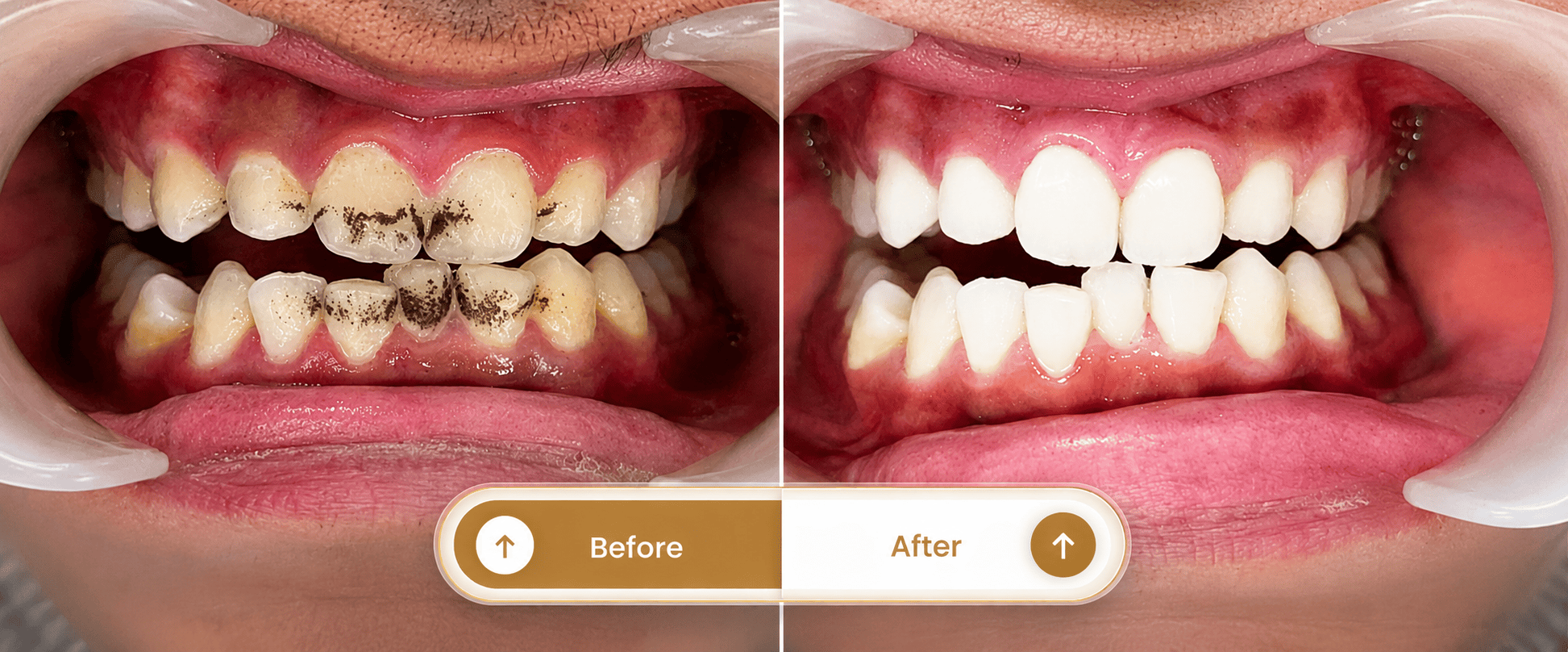 Smile transformation 2